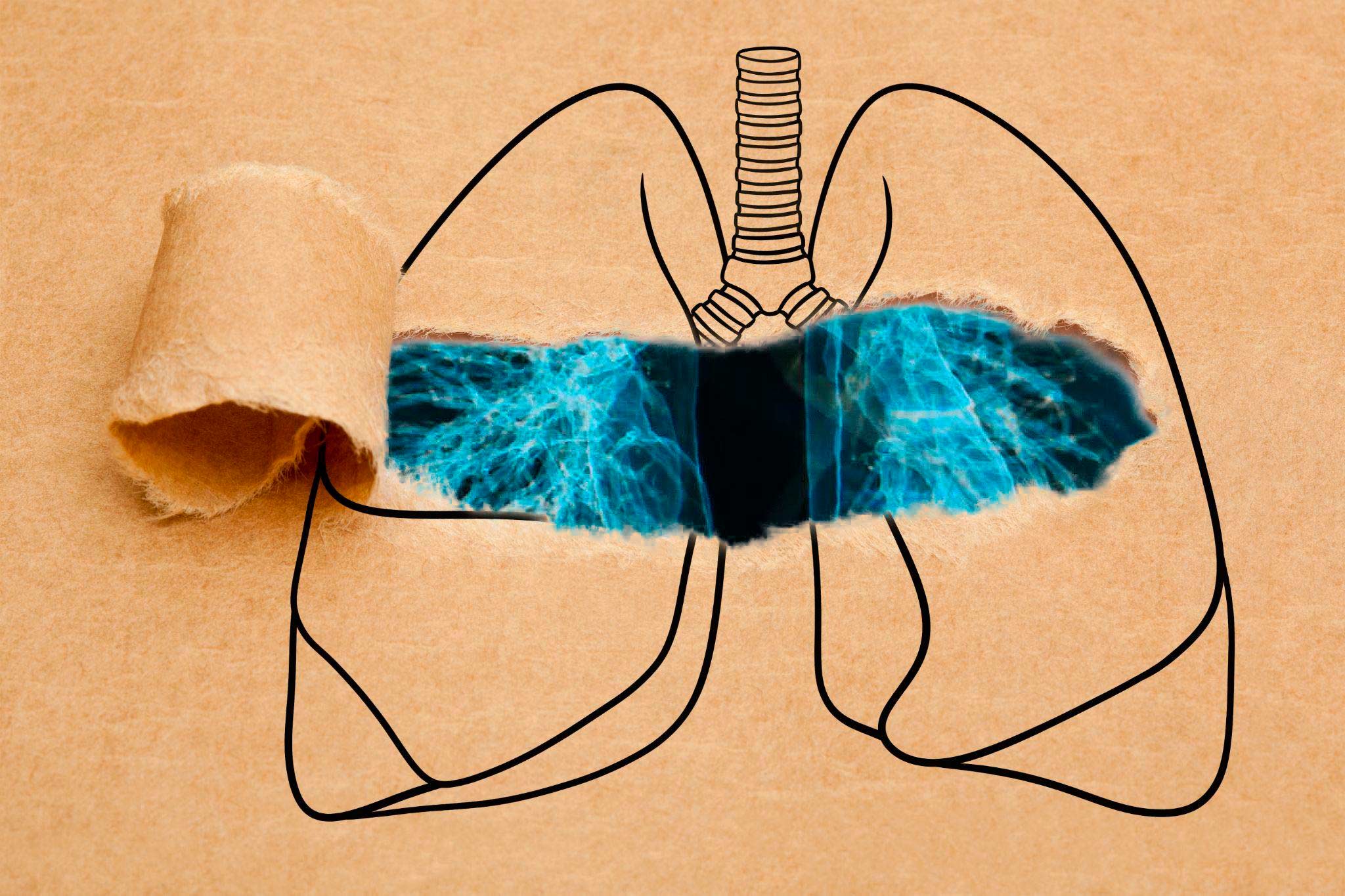 Top 3 Reasons Why Patients Choose IPF Clinical Trials for Treatment and Diagnosis Top 3 Reasons Why Patients Choose IPF Clinical Trials for Treatment and Diagnosis